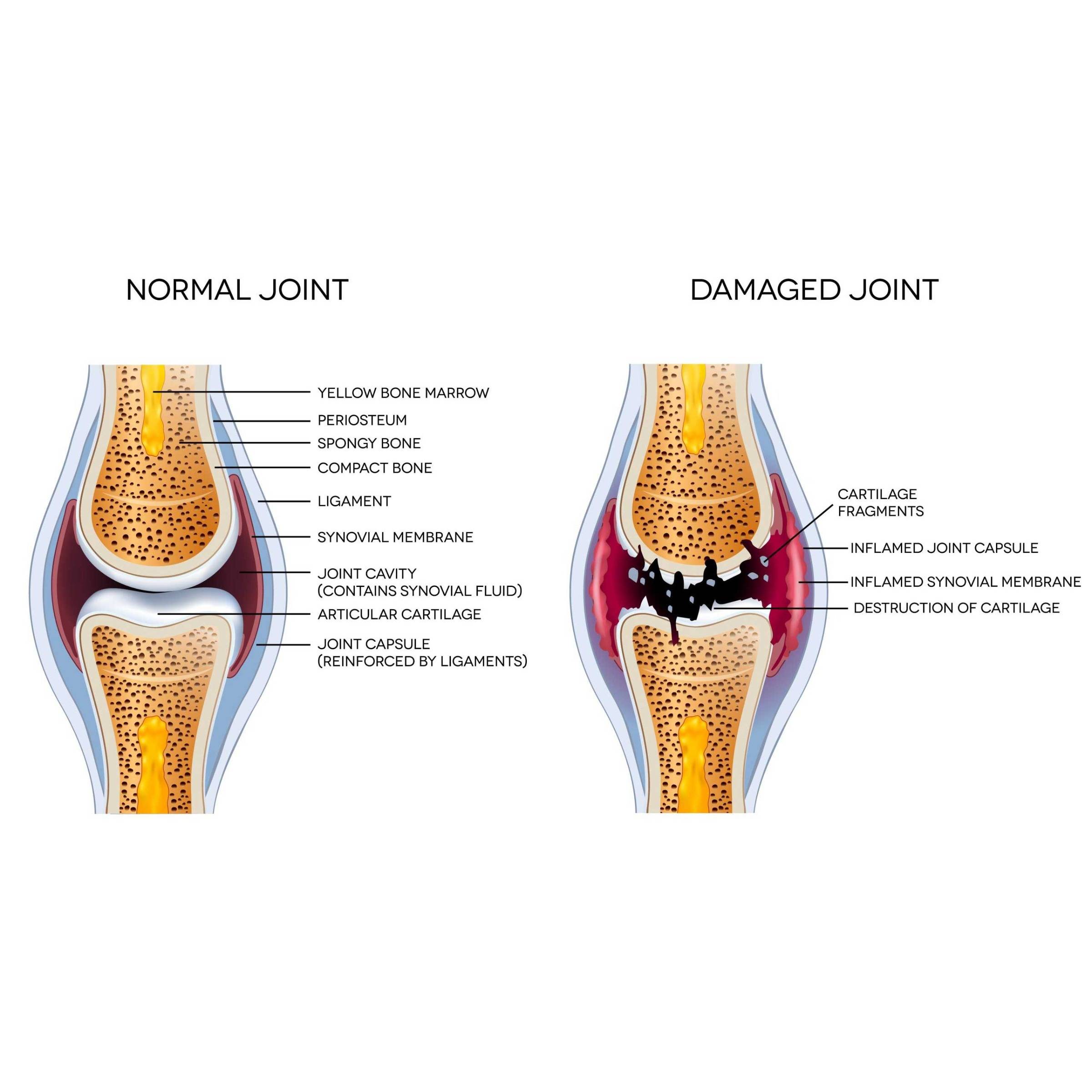 Osteoarthritis - Signs of Inflammation