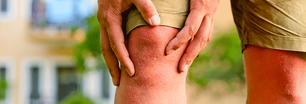 Close-up of a person holding their red, inflamed knee, possibly seeking relief with natural pain supplements.