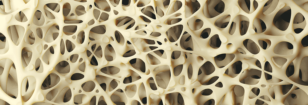 The 4 Stages of Osteoporosis